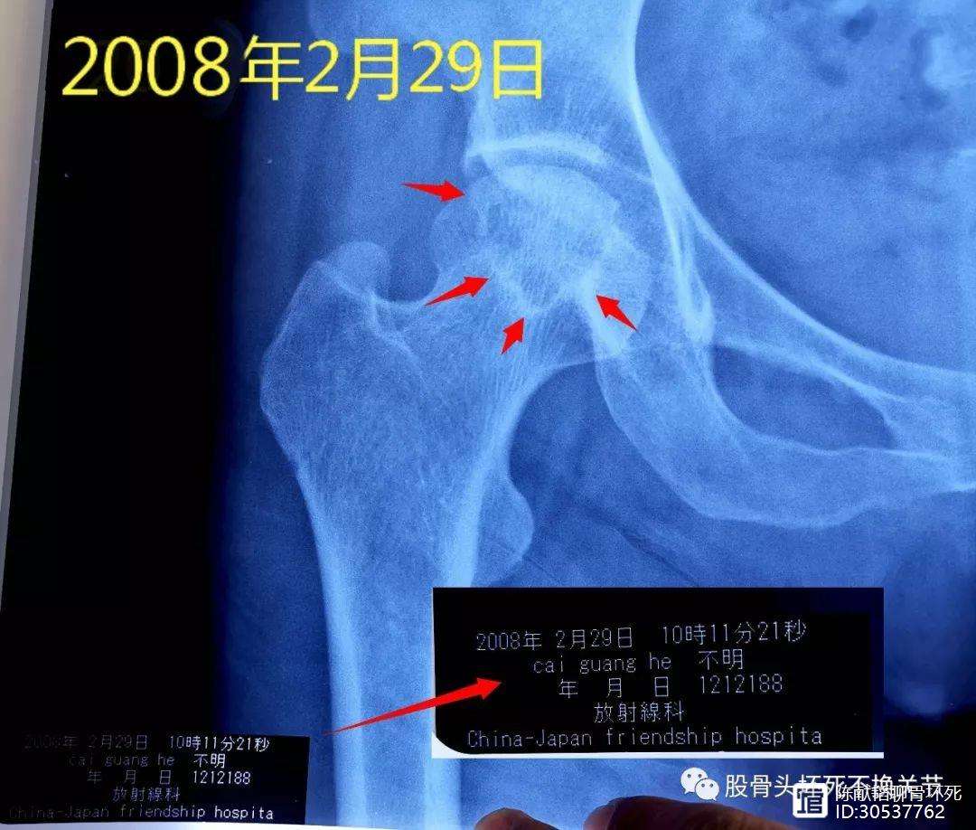 盘锦人工骨头医保报销多少(人工骨头医保报销多少比例)