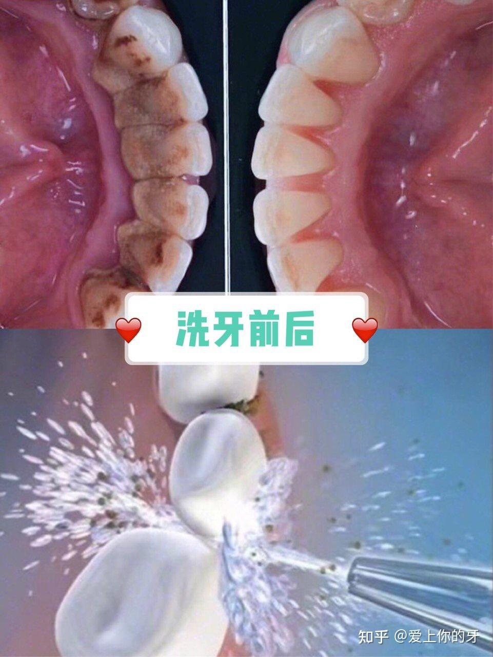 盘锦洗牙可以用医保吗(洗牙可以用医保吗,报销比例多少)